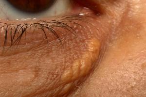 Picture showing a plaque of xanthelasma on the eyelid