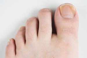 Picture showing nail discolouration caused by fungal infection