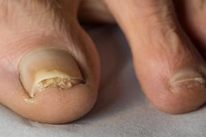 A toenail lifting off due to infection Picture showing a toenail lifting off due to infection