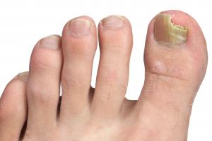 A broken toenail due to infection Picture showing broken toenail