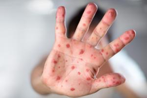 Picture showing hand, foot and mouth disease rash on the palm of a hand