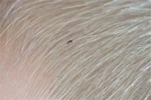 Picture of head lice, a tiny inset that lives in hair