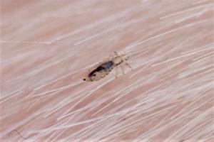 close up picutre of a head lice in hair