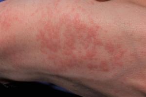Picture showing prickly heat (heat rash) on the back of a hand