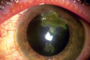 An eye infection caused by the herpes simplex virus