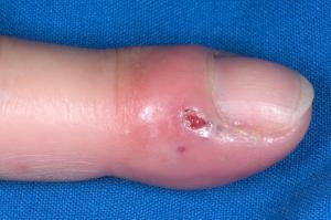 Picture showing a sore on the finger caused by herpetic whitlow