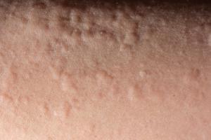 Picture showing urticarial rash (hives) Picture showing urticarial rash