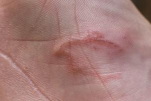 Rash on sole of foot, caused by the burrowing larvae of a hookworm Rash on sole of foot, caused by the burrowing larvae of a hookworm