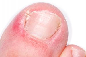 Close-up picture of an ingrown toenail