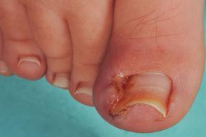 Picture of toenail with pus and inflammation