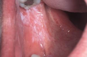 Lichen planus in a mouth, inside right cheek Lichen planus in a mouth, inside right cheek