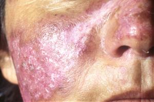 Lupus rash on the face