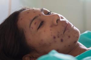 An adult with measles rash Picture of the face of a woman with measles