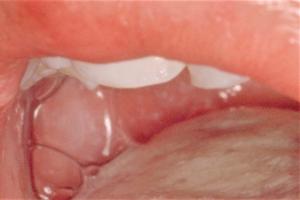 Picture showing small greyish-white spots (Koplik spots) in the mouth caused by measles