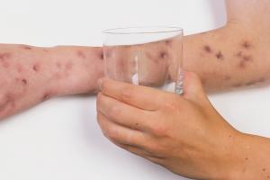 Child’s arm with a blotchy rash that doesn't fade when a glass is rolled over