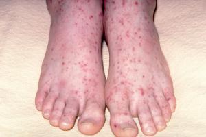 Picture of meningitis rash on feet