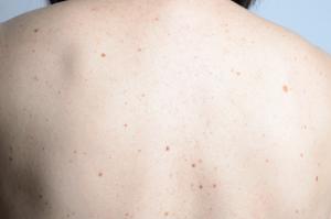 A back with scattered moles and freckles
