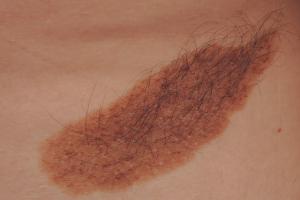 A mole with hair growing from it