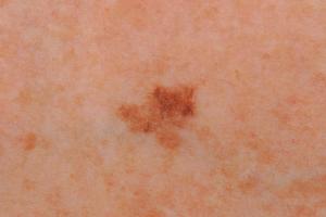 Flat mole with different shades of colour Flat mole with different shades of colour