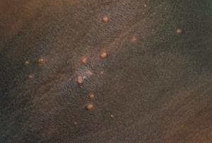 Picture showing molluscum contagiosum skin infection that causes clusters of small, firm, raised spots