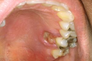 Mouth ulceration on the roof of the mouth
