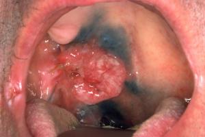 Cancer of the mouth Cancer of the mouth