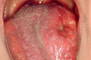 Cancer of the tongue