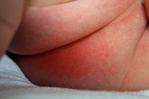 Picture showing nappy rash on a baby’s bottom