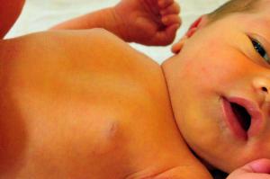 A newborn baby with jaundice