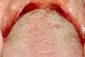 Picture of mouth with oral thrush showing redness and white patches