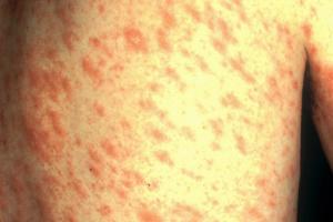Red scaly patches caused by pityriasis rosea Picture showing red scaly patches caused by pityriasis rosea