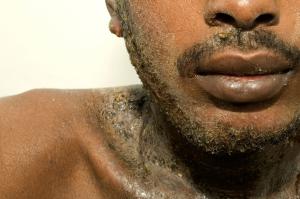Psoriasis on face and neck Picture of psoriasis on face and neck