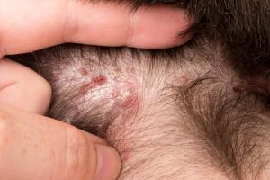 Picture of psoriasis affecting the scalp