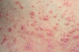 Guttate psoriasis on a back Picture of a back showing guttate psoriasis