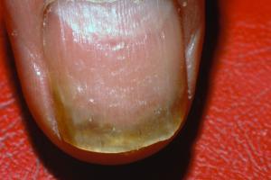 Picture of a fingernail with nail involvement caused by psoriasis
