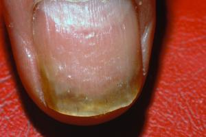 A fingernail with nail involvement caused by psoriasis Picture of a fingernail with nail involvement caused by psoriasis