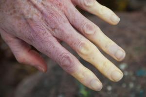 Picture of pale fingers caused by Raynaud’s