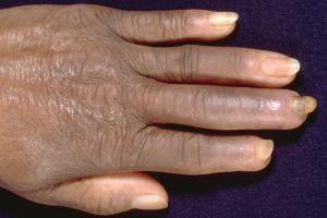 Raynaud’s causing paleness in the fingertips Raynaud’s causing paleness in the fingertips