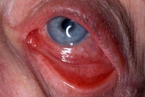 Inflamed eye due to iritis Inflamed eye due to iritis