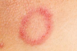 Picture of ringworm rash, which is usually ring-shaped, unless it's on the face, neck or scalp
