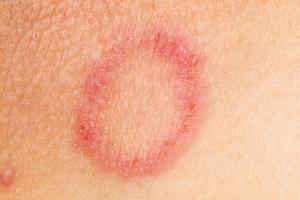 Picture of ringworm rash Picture of ringworm rash, which is usually ring-shaped, unless it's on the face, neck or scalp