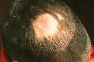 Picture of ringworm rash on the scalp
