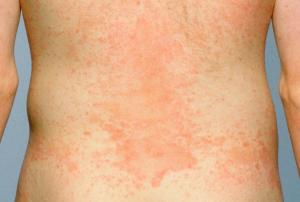 Picture of ringworm rash covering a large area on the body