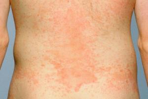 Ringworm rash covering a large area on the lower back Picture of ringworm rash covering a large area on the body