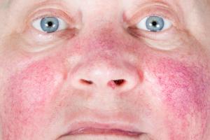 Rosacea skin condition on a woman’s face