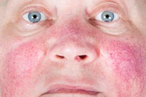 Rosacea skin condition on a woman’s face Rosacea skin condition on a woman’s face