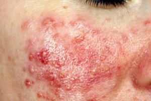 Close up of Acne rosacea on a face Close up of Acne rosacea on a face