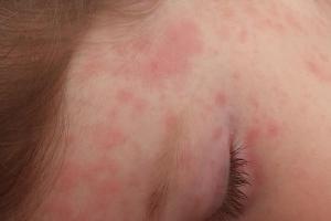 Roseola skin rash on a girl’s face