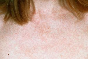 Rubella rash on a chest