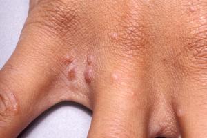 Picture of scabies rash appearing between the fingers